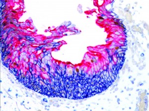 cd44-ck20-p53-reacAtypia-Bladder