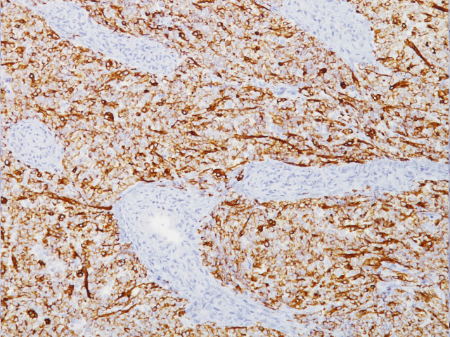 Immunohistochemistry antibody Panel for Sarcoma