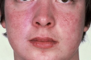 mild-contact-dermatitis-face
