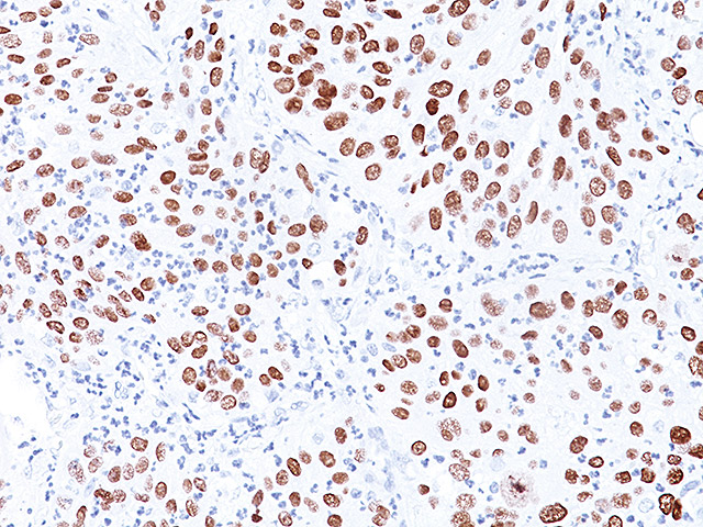 lung SqCC stained with p40 Monoclonal antibody