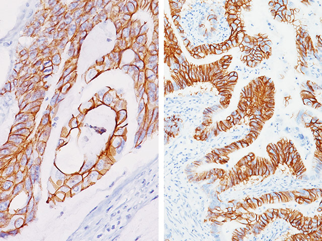 CK7, CK20, CDX2 and MUC2 Immunohistochemical staining used to distinguish metastatic colorectal carcinoma involving ovary from primary ovarian mucinous adenocarcinoma.