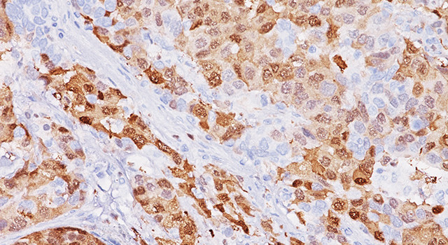 A novel rabbit monoclonal antibody arginase-1 is highly specific and highly sensitive in hepatocellular carcinoma
