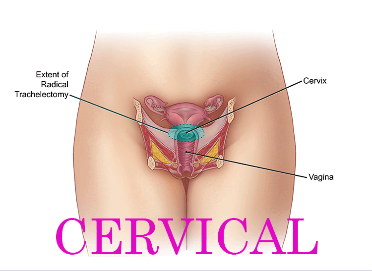 Spondylosis-Cervical