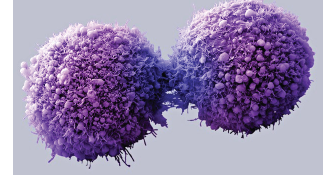 Mutasi gen baru pemicu kanker payudara ditemukan!