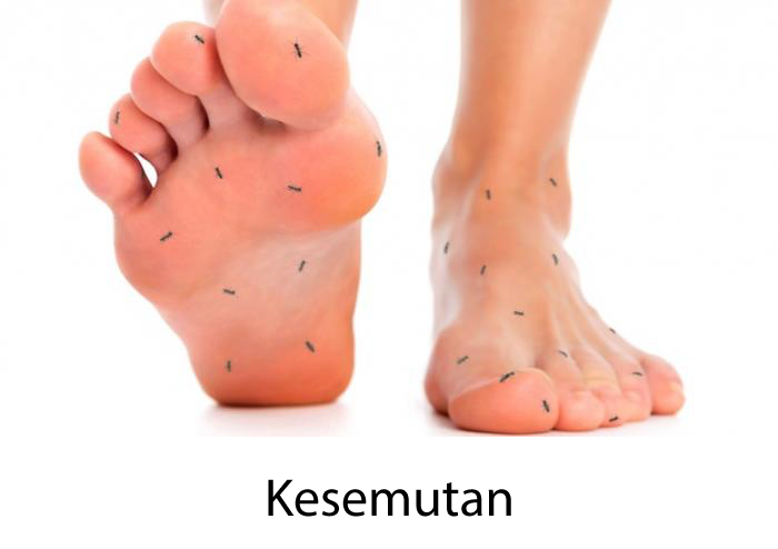 kesemutan